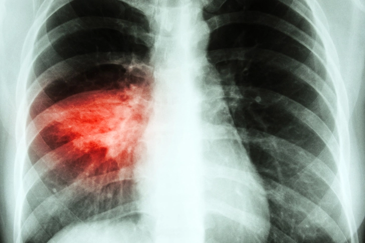 Pneumonia