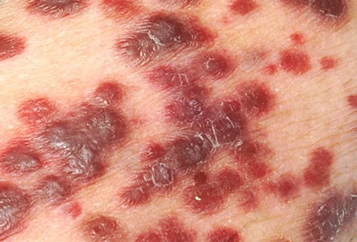 Symptoms of AIDS Symptoms of AIDS