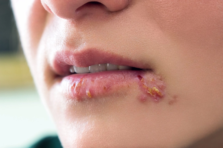 Herpes Simplex Herpes Simplex
