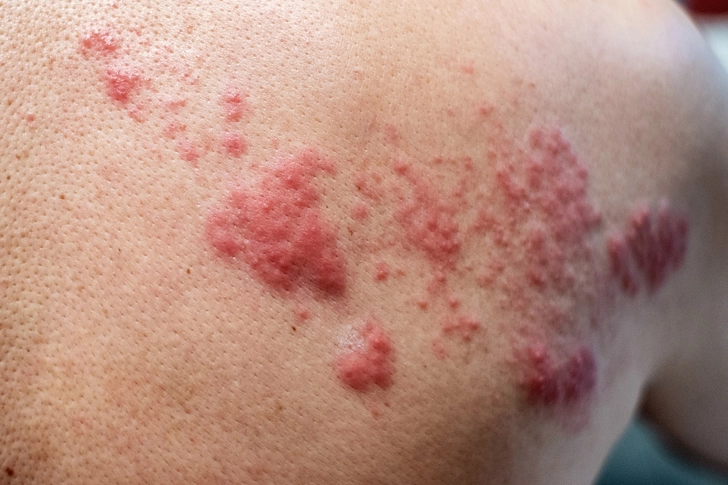 Shingles (Herpes Zoster) Shingles (Herpes Zoster)