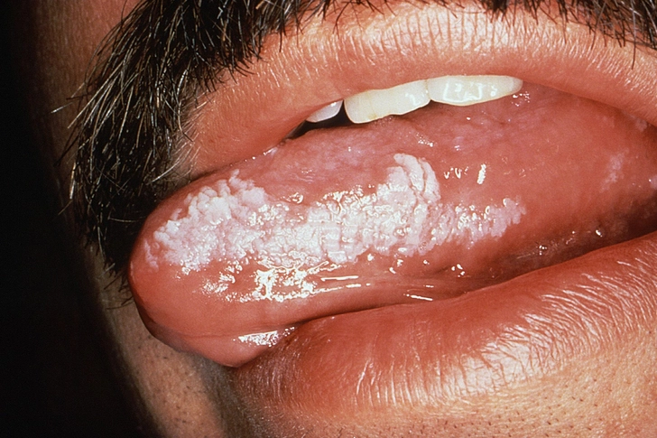 Oral Hairy Leukoplakia Oral Hairy Leukoplakia