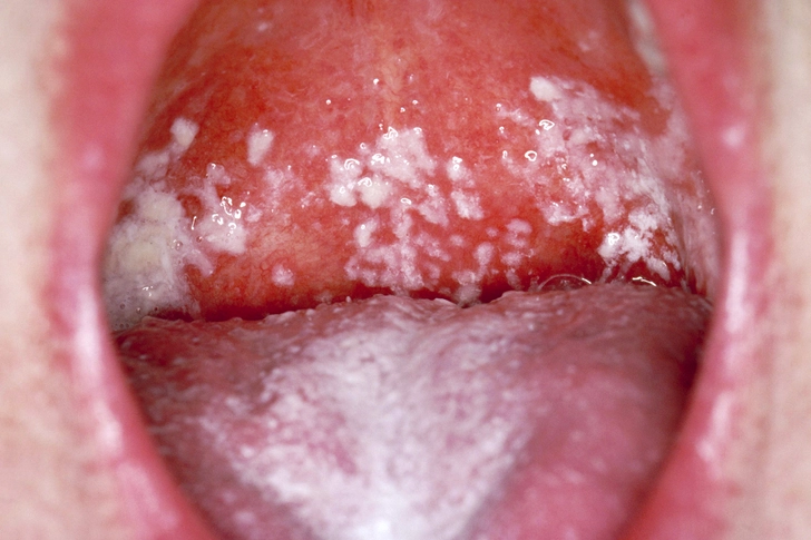 Oral Thrush Oral Thrush