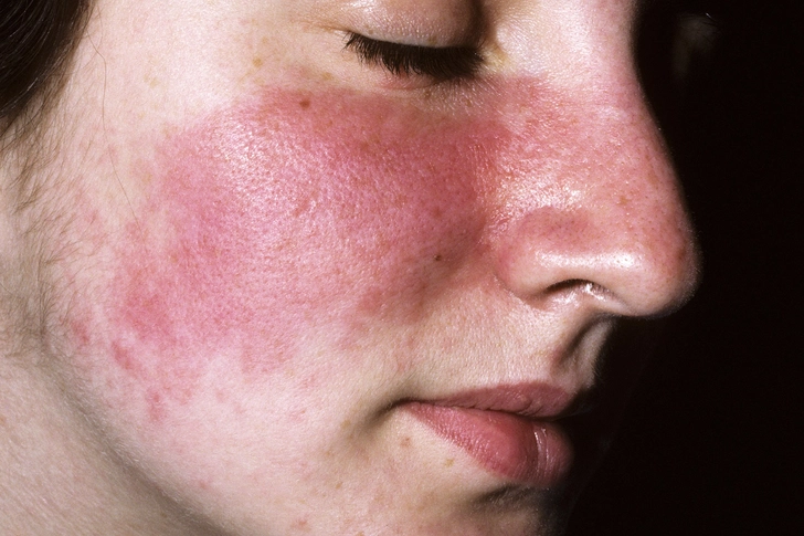 Photodermatitis Photodermatitis