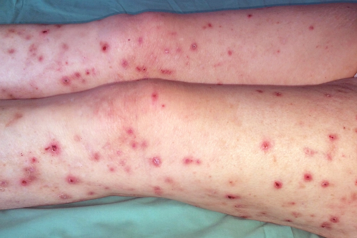 Prurigo Nodularis Prurigo Nodularis