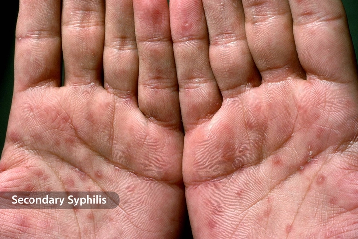 Syphilis Rash Syphilis Rash