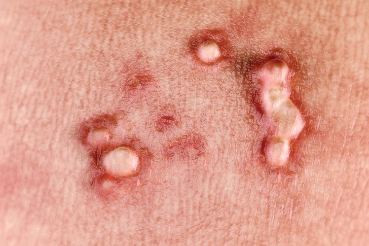 Genital Warts Genital Warts