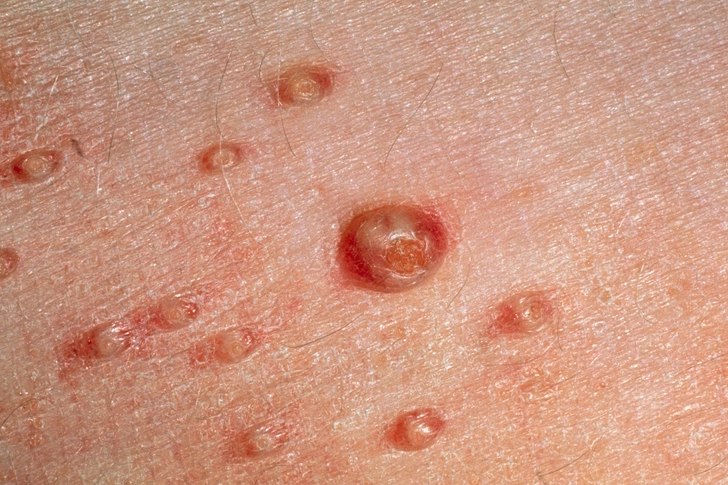 Molluscum Contagiosum Molluscum Contagiosum