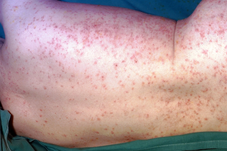 Scabies Scabies