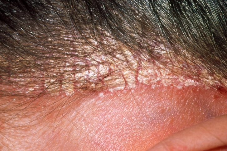 Seborrheic Dermatitis Seborrheic Dermatitis