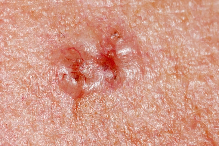 Skin Cancer Skin Cancer