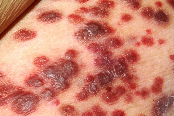 Kaposi Sarcoma Kaposi Sarcoma