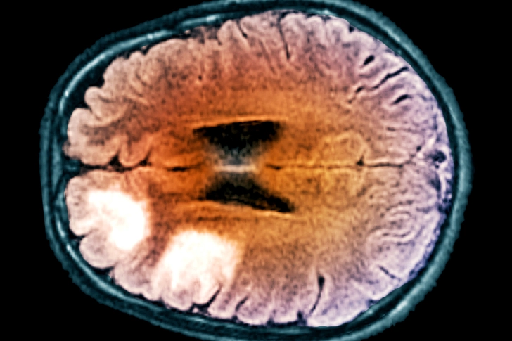 Progressive Multifocal Leukoencephalopathy (PML) Progressive Multifocal Leukoencephalopathy (PML)