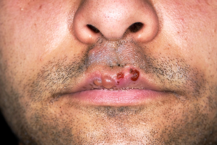 Herpes Simplex Virus (HSV) Herpes Simplex Virus (HSV)