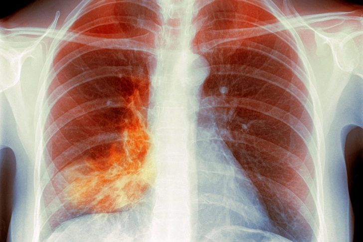 Pneumocystis Pneumonia (PCP) Pneumocystis Pneumonia (PCP)