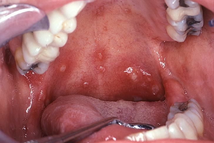 Skin and Mouth Sores