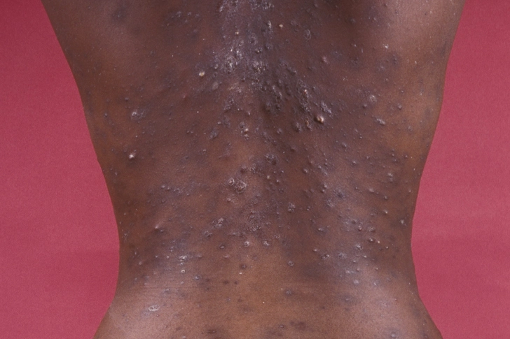 Rash Rash