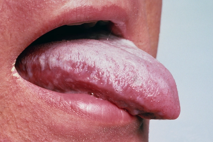 Yeast Infection