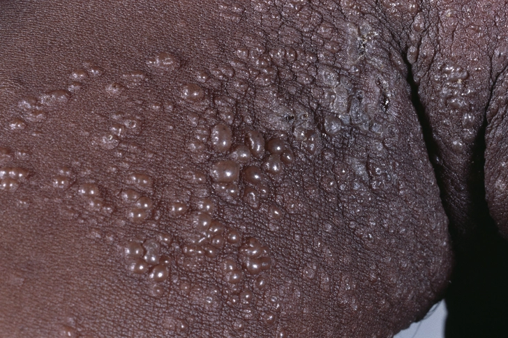 Shingles Shingles