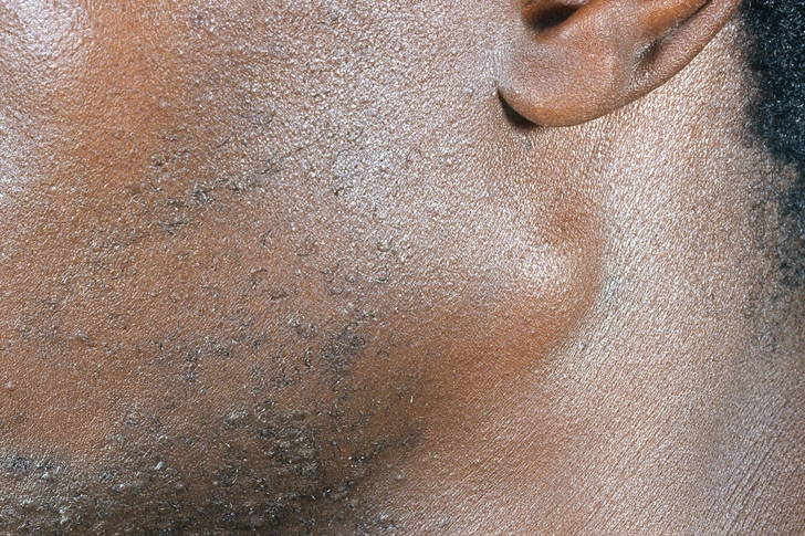 Swollen Lymph Nodes