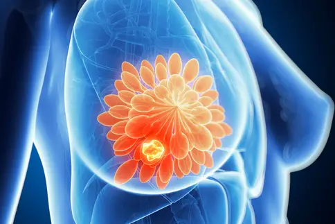 photo of breast cancer