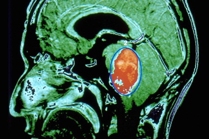 What Is a Brain Tumor?