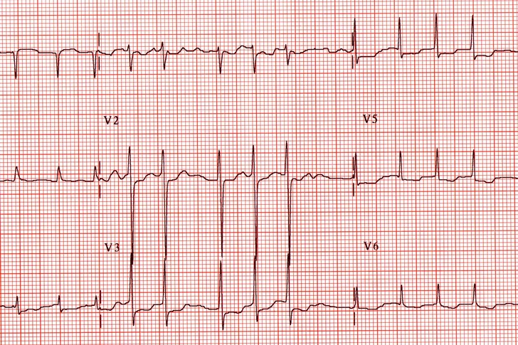 Heart Rhythm Changes