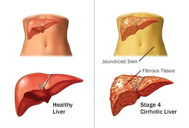 The Steps to Liver Disease