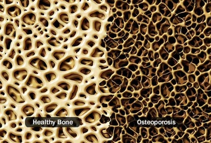 Thin Bones, Less Muscle Thin Bones, Less Muscle