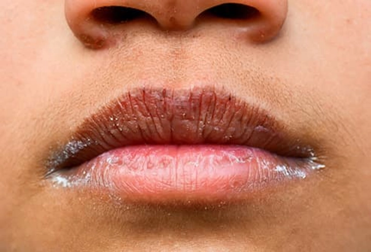 High: Dry Mouth High: Dry Mouth