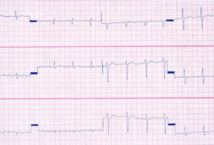 Low: Weird Heartbeat Low: Weird Heartbeat