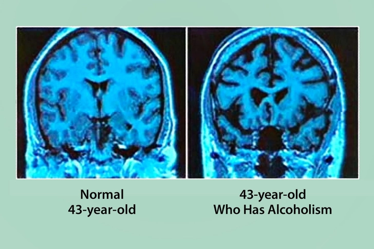 Alcohol Use Disorder Alcohol Use Disorder