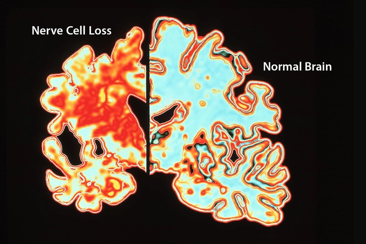 Alzheimer’s Disease Alzheimer’s Disease