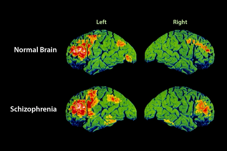 Schizophrenia