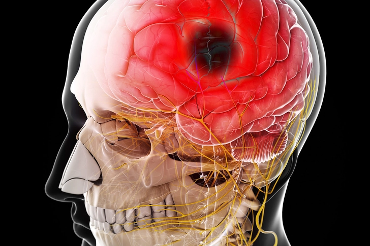 Brain-Related Problems