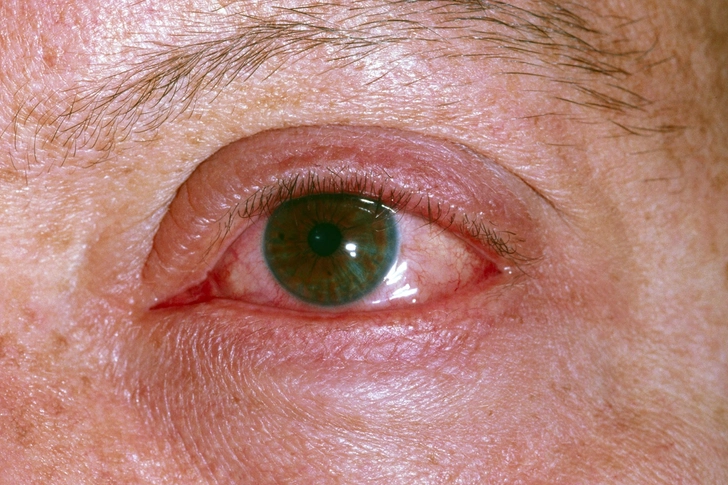 Eye Problems