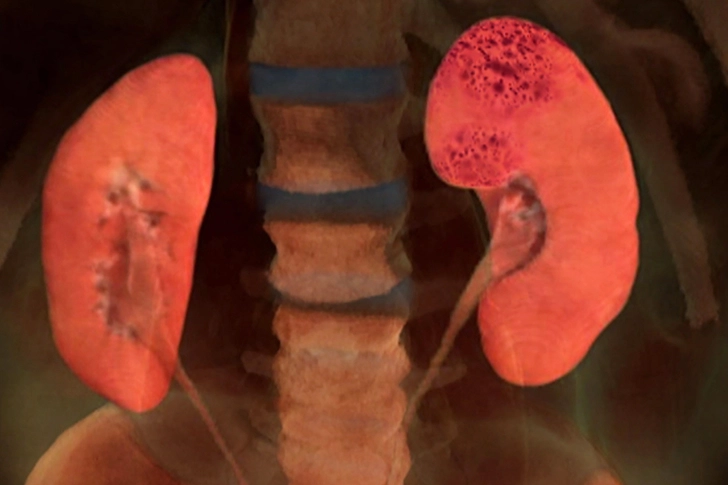 Kidney Damage Kidney Damage