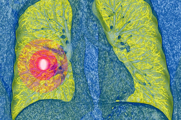 Lung Cancer Lung Cancer