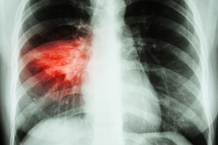 Pneumonia Pneumonia
