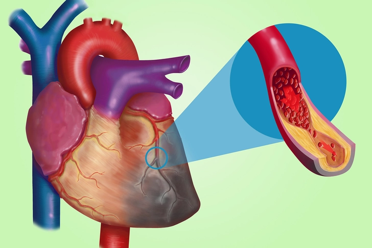 Heart Disease Heart Disease