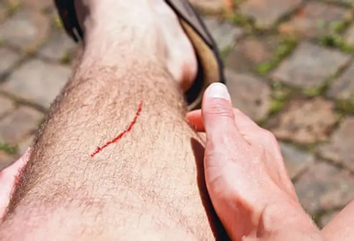 Which Wounds Can You Treat at Home? Which Wounds Can You Treat at Home?