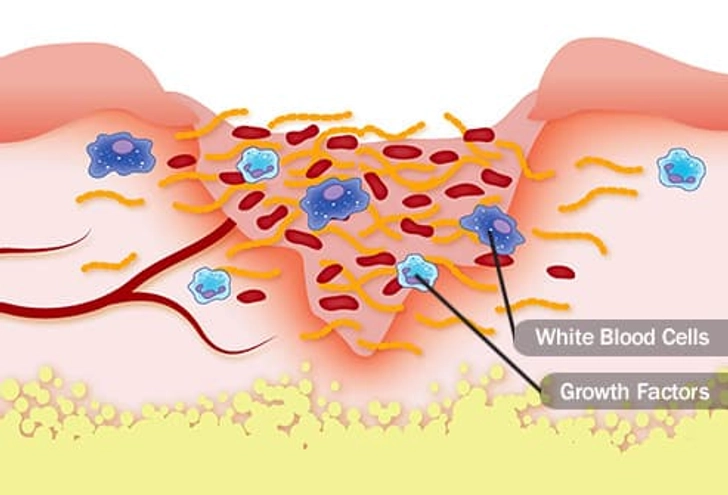 Stage 2: Inflammation Begins Stage 2: Inflammation Begins
