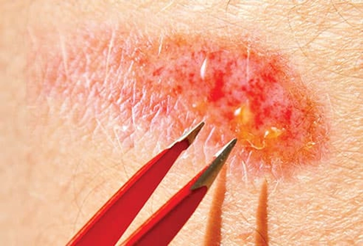 Wound Care Step 4: Remove Debris