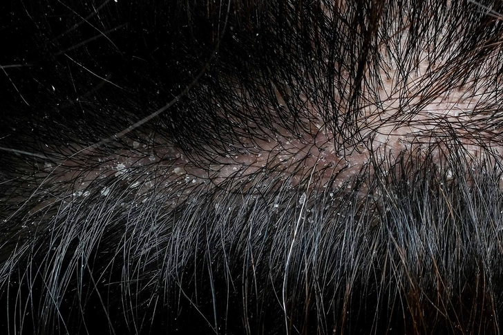 Dandruff