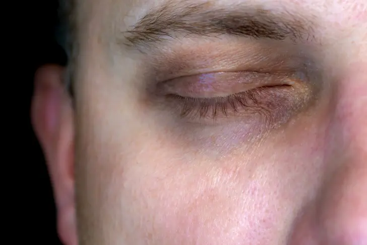 Dark Circles