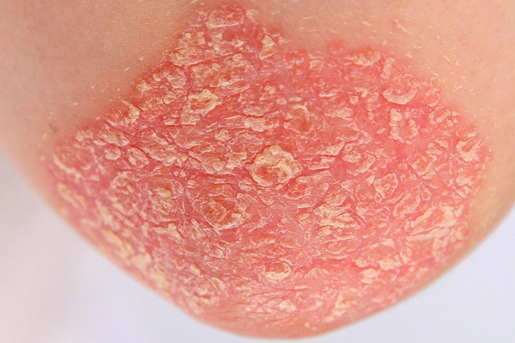 Psoriasis