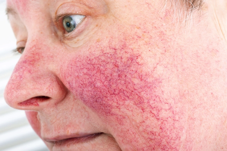 Rosacea