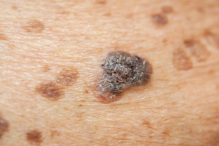 Skin Cancer Skin Cancer