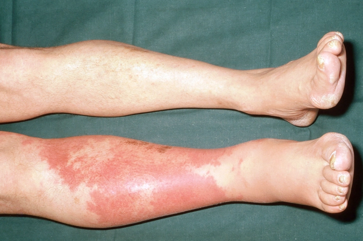 Cellulitis
