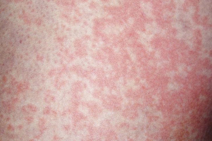 Hives