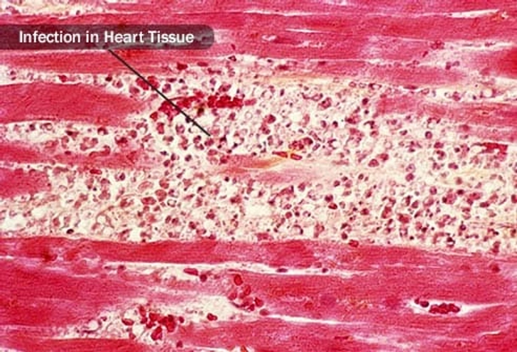 Heart Infections Heart Infections